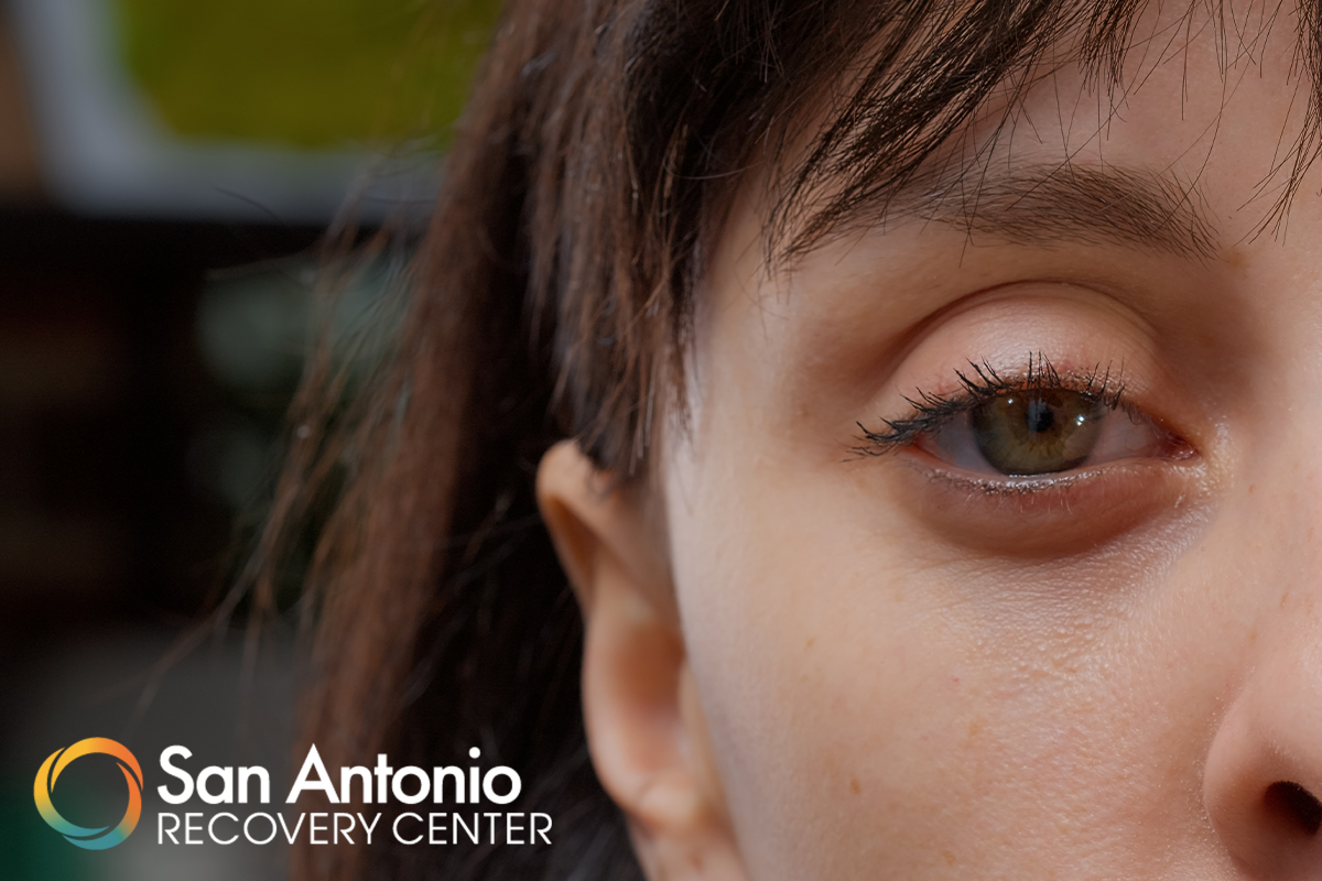 what drugs cause glassy eyes san antonio recovery center